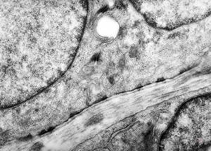 M, 1y. | epidermolysis bullosa … junctional type … rudimentary hemidesmosomes, missing anchoring fibrils M, 1y. | epidermolysis bullosa … junctional type … rudimentary hemidesmosomes, missing anchoring fibrils